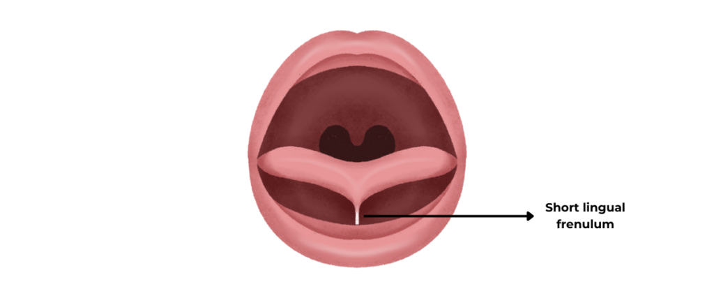 Ankyloglossia/Tongue-tie is caused by a short lingual frenulum