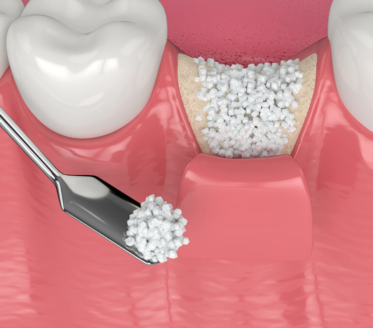 Bone Grafting - Specialist Dental Group