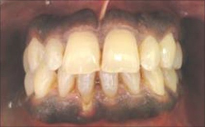 Dark coloured gums 